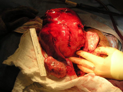 embolization4